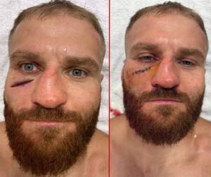 Jan Blachowicz Reveals Brutal Facial Injury After UFC Belgrade Defeat images 2026 08 03T082440.785
