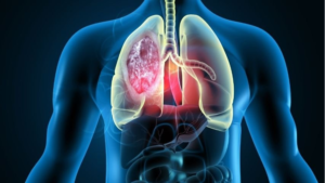 Pope Leo’s Lung Surgery Succeeds as Nodule Raises Health Questions IMG 5431